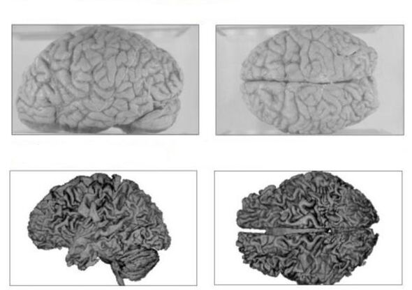 Egy egészséges ember agya (fent) és egy alkoholista agya visszafordíthatatlan következményekkel (lent)