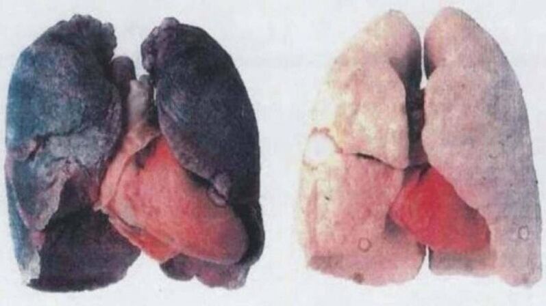 Sok krónikus alkoholista hal meg tüdőkárosodás következtében (balra)